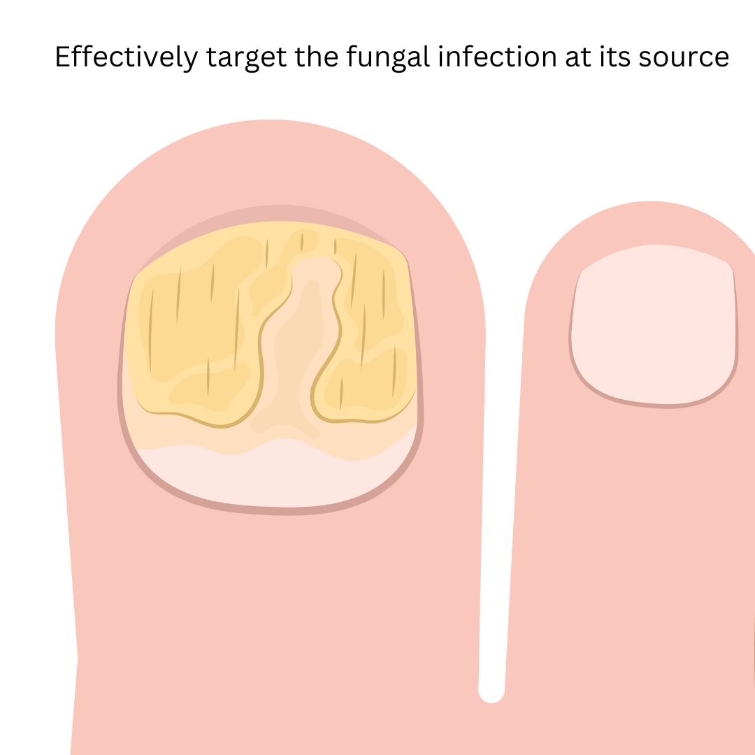 At-Home Laser Solution: DIY Device for Effective Fungal Nail Treatment